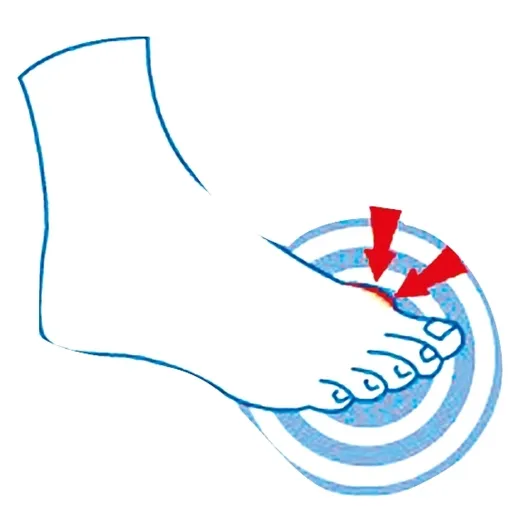 Protection hallux valgus Epitact®